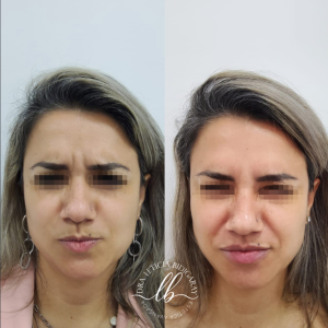 botox florianopolis-SC