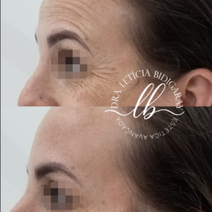 botox florianopolis-SC