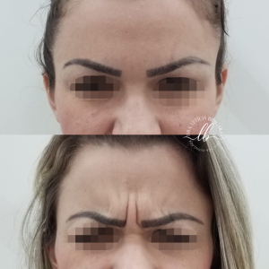 botox florianopolis-SC