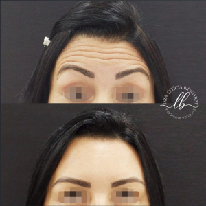 botox florianopolis-SC