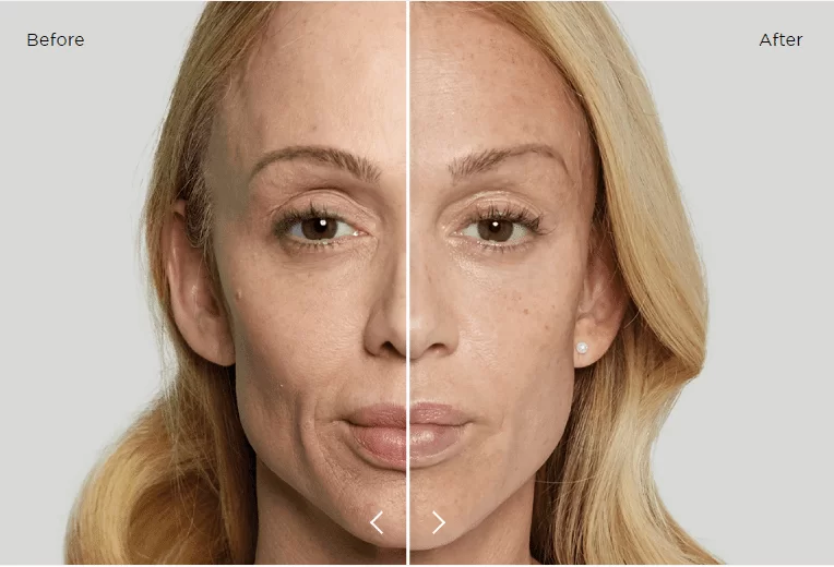 Bioestimuladores de colágeno para estética facial e corporal